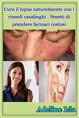 Cura il lupus naturalmente con i rimedi casalinghi - Smetti di prendere farmaci costosi (Italian Edition)