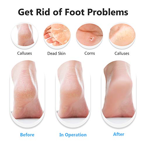 Feagar Lima Pies para quitar Dureza y Callo Duro, Kit Pedicura Lija para Durezas Pies, Raspador para Talones Secos y Agrietados