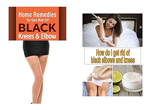 How do I get rid of black elbows and knees : Ultimate Guide for women (English Edition)