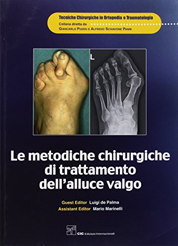 Le metodiche chirurgiche di trattamento dell'alluce valgo (Tecniche chirurg in ortopedia e traumato)