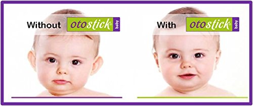 Otostick Baby Cosmetic Ear Correctors
