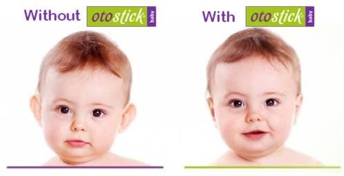 Otostick Baby Cosmetic Ear Correctors