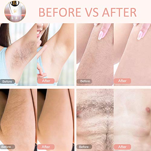 Sistema de dispositivo de depilación permanente IPL para piernas de mujeres, axilas, área de bikini y cuerpo