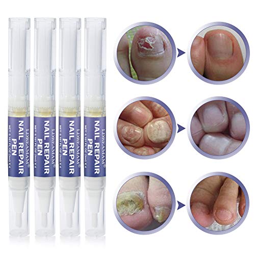 Tratamiento de Uñas,Hongos Uñas Pies,Nail Fungus,Hongo Uñas Tratamiento,Retirar Dedos Infectados Amarillos, Cuidado de Uñas Seguro y Natural