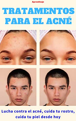 Tratamientos para el acné: Combate el acné, cuida tu cara, cuida tu piel desde hoy