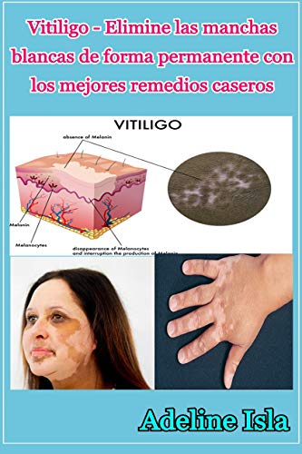 Vitiligo - Elimine las manchas blancas de forma permanente con los mejores remedios caseros