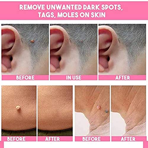 YsaAsaa - Eliminar verrugas de 20 ml, etiquetas de piel de 5 ml