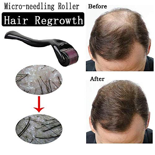 ZZSNT Hair Regrowth Activating Roller, Micro-needling Roller Beard Growth Product Anti Hair Loss