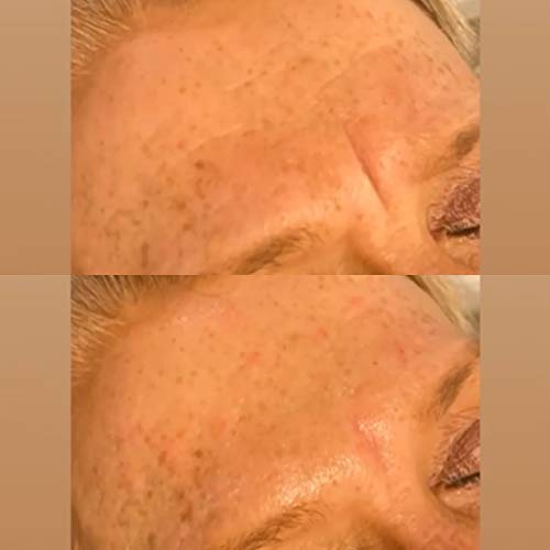 Hyalax Agri-Fix Argireline 10% – alternativa suave a la toxina botulínica A, 2 ml