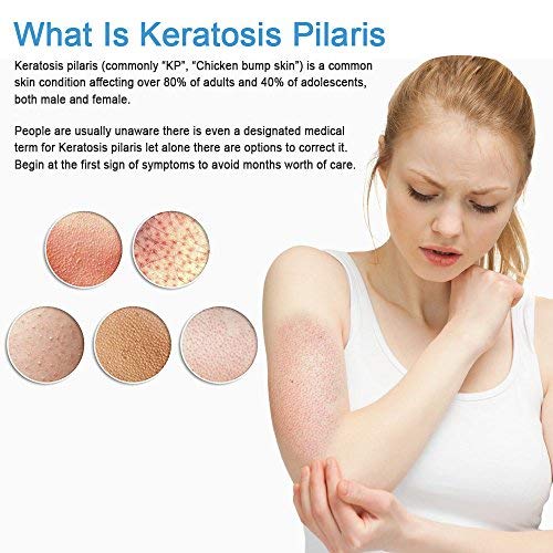 KP Essentials - Queratosis Pilaris Crema Esfoliante - Riduci Il Rossore Su Gambe e Braccia Per una Pelle Chiara e Brillante - 110 gr. (1 Bottiglia)