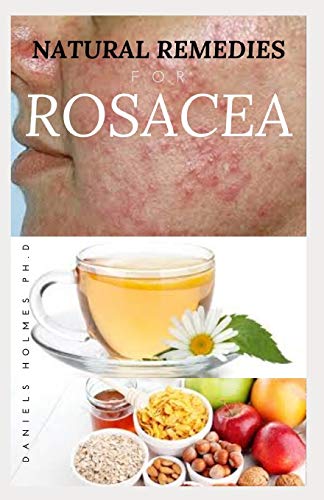 NATURAL REMEDIES FOR ROSACEA: Treating Rosacea with Natural Home Remedies Includes Nose Redness,Acne,Eczema and Lots More