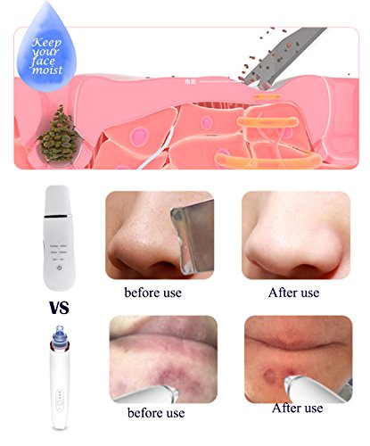 VOUMEY Dispositivo ultrasónico de limpieza de la piel facial Eliminación de la espinilla Máquina de depuración de la pala Exfoliante facial Limpiador Instrumento Limpiador de poros (blanco)
