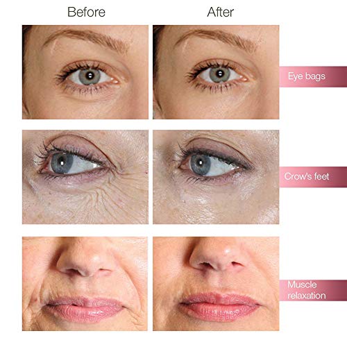 XHH 0,3 Ml Hyaluron Pen Kit + 5 Cabeza de Ampolla para Labio de Relleno Anti Arrugas Levantamiento Facial Pluma Hialuron