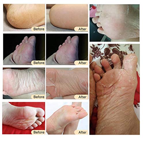 yotijar Baby Soft Foot Peeling Mascarilla Calcetines Callos Exfoliantes Piel - Árbol del té