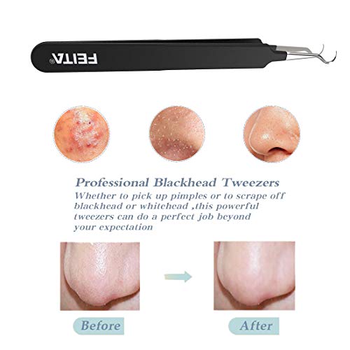 Herramienta de pinzas de extracción de acné con espinillas curvas y de grado quirúrgico FEITA Pro y quirúrgicas para eliminar los poros de cabeza blanca y obstruidos, espinilla