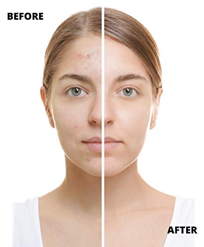 Hivexagon Kit Derma Roller 3-en-1-3 Cabezales Derma Separados 180c/600c/1200c en Tamaños 0.5mm, 1.0mm y 1.5mm Reduce las Imperfecciones de la piel: Acné, Cicatrices Profundas, Estrías HG089