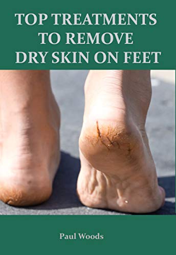 TOP TREATMENTS TO REMOVE DRY SKIN ON FEET (English Edition)