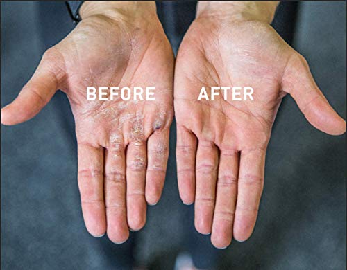 Bloqaid Producto para Eliminar los Callos de Las Palmas de Las Manos de Atletas: Guantes sin Piedra pómez Que eliminan los Callos en 5 Minutos