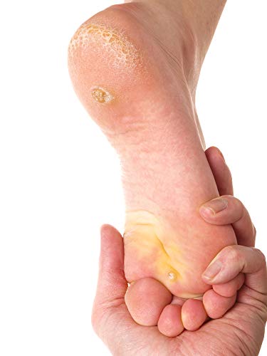 Gel para Suavizar la Piel Callosa de los Pies, contiene Urea, Ácido Salicílico y Ácido Láctico, 20 ml
