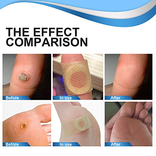 J TOHLO Verrugas, Wart Remover, Tratamiento Anti Verrugas Tratamiento para Quitar Verrugas Comunes y Plantares, Removedor de Callos de Verrugas, Invade y Elimina Verrugas Comunes y Plantares, Callos