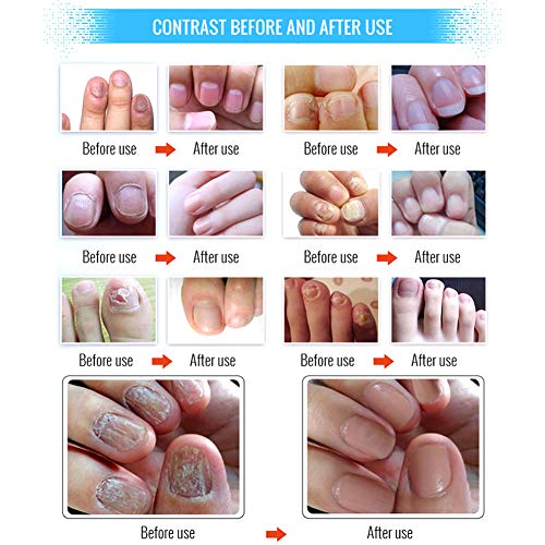 Líquido reparador de uñas El hongo Yiitay líquido deja de ser efectivo contra el hongo de uñas Reparación de onicomicosis y fortalecimiento de uñas de los pies y uñas