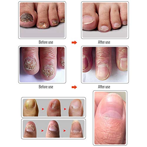 Líquido reparador de uñas El hongo Yiitay líquido deja de ser efectivo contra el hongo de uñas Reparación de onicomicosis y fortalecimiento de uñas de los pies y uñas