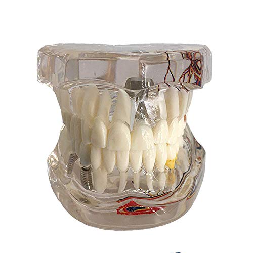 Molde Educativo, Modelo de patología Dental, Modelo de Dientes dentales Estudio Transparente Implante patológico Dientes Humanos Adultos Modelo de Nervios Educación del Paciente