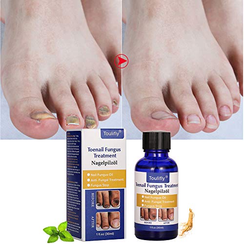 Solución de uñas micóticas, Tratamiento de Uñas de los hongos, Apto para dedos y pedicura, Solución de uñas de Hongos para uñas descoloridas, Gruesas, desmenuzadas y con Hongos