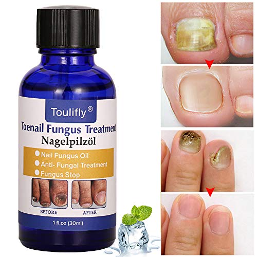 Solución de uñas micóticas, Tratamiento de Uñas de los hongos, Apto para dedos y pedicura, Solución de uñas de Hongos para uñas descoloridas, Gruesas, desmenuzadas y con Hongos