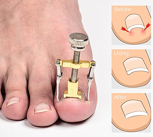 WeeDee - Uñas Encarnadas Corrector, Pedicura Tratamiento Para Defecto De Crecimiento De Las Uñas Paronychia Ingrown Toenail