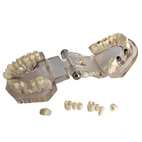 YZ-YUAN Ensamblaje Modelo de patología Dental, Modelo de Dientes dentales Estudio Transparente Implante patológico Dientes Humanos Adultos Modelo de Nervios Educación del Paciente para la Escuela, e