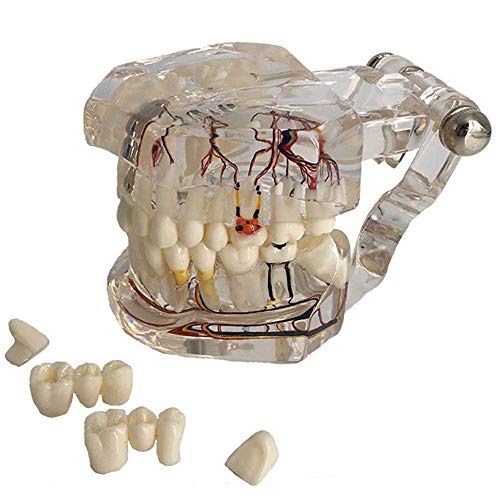 YZ-YUAN Ensamblaje Modelo de patología Dental, Modelo de Dientes dentales Estudio Transparente Implante patológico Dientes Humanos Adultos Modelo de Nervios Educación del Paciente para la Escuela, e