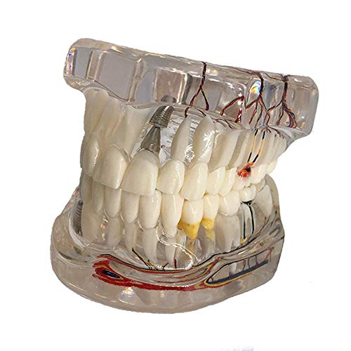 YZ-YUAN Ensamblaje Modelo de patología Dental, Modelo de Dientes dentales Estudio Transparente Implante patológico Dientes Humanos Adultos Modelo de Nervios Educación del Paciente para la Escuela, e