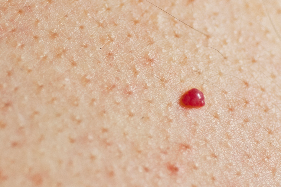 13 Causas de las manchas rojas, rosadas o marrones en la piel, según los dermatólogos