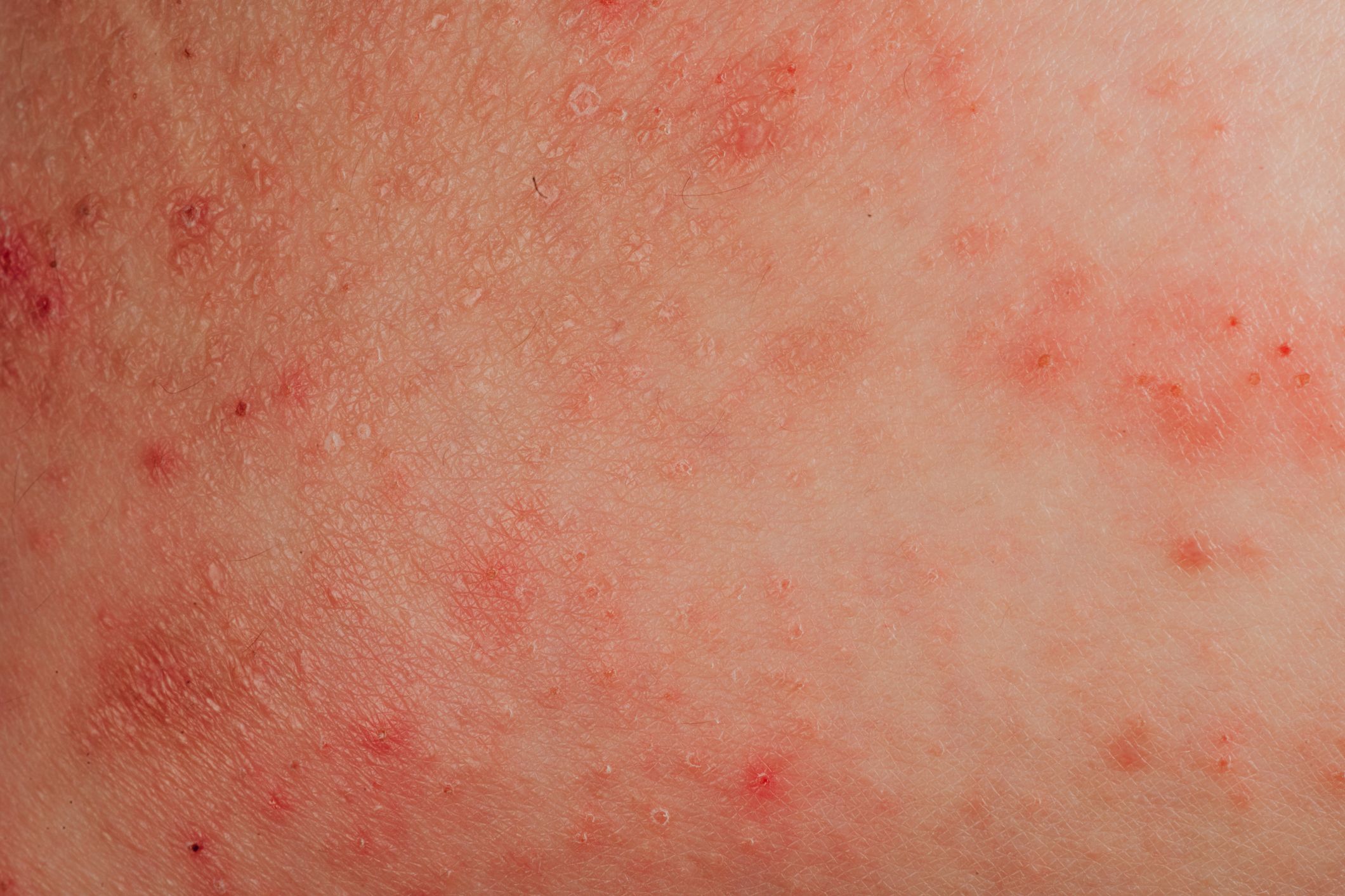 13 Causas de las manchas rojas, rosadas o marrones en la piel, según los dermatólogos