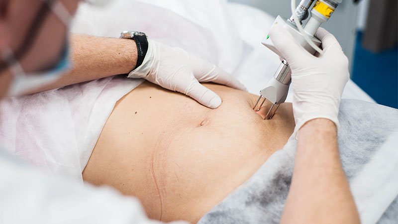 Cómo eliminar las estrías para siempre