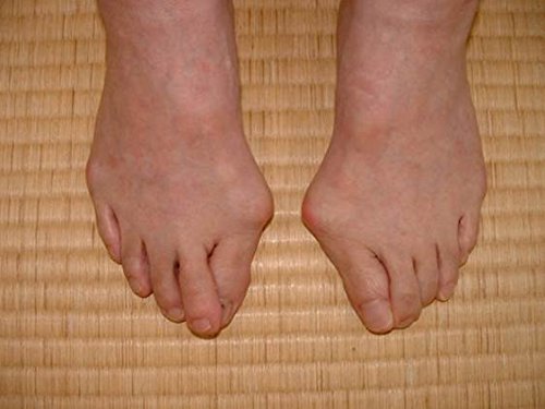 bochikun juanete (hallux valgus) ortesis 1 set (d e i) tamaño XL