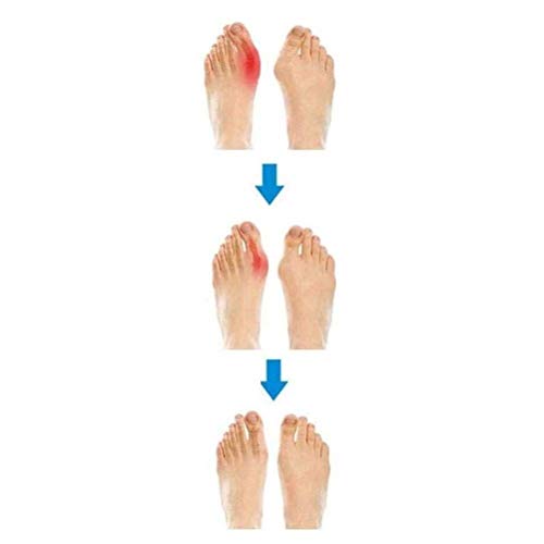 QLIGHA Corrector de juanetes ortopédico para Mujer Sandalias de corrección de pie con Dedo Gordo Suave Informal para Mujer Zapatos de Cuero de PU Zapatilla de Suela Plana con Plataforma cómoda, Neg