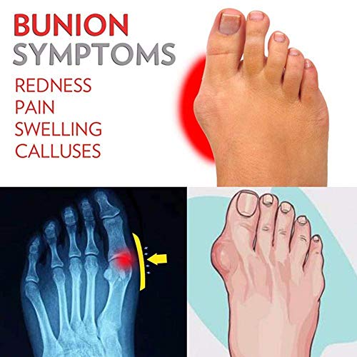 TOT Valgus Bunion Foot Corrector Sandals Mujeres Calzado ortopédico para Huesos del Dedo Gordo del pie con Soporte para el Arco para el Alivio del Dolor Síntomas del juanete,Blanco,37