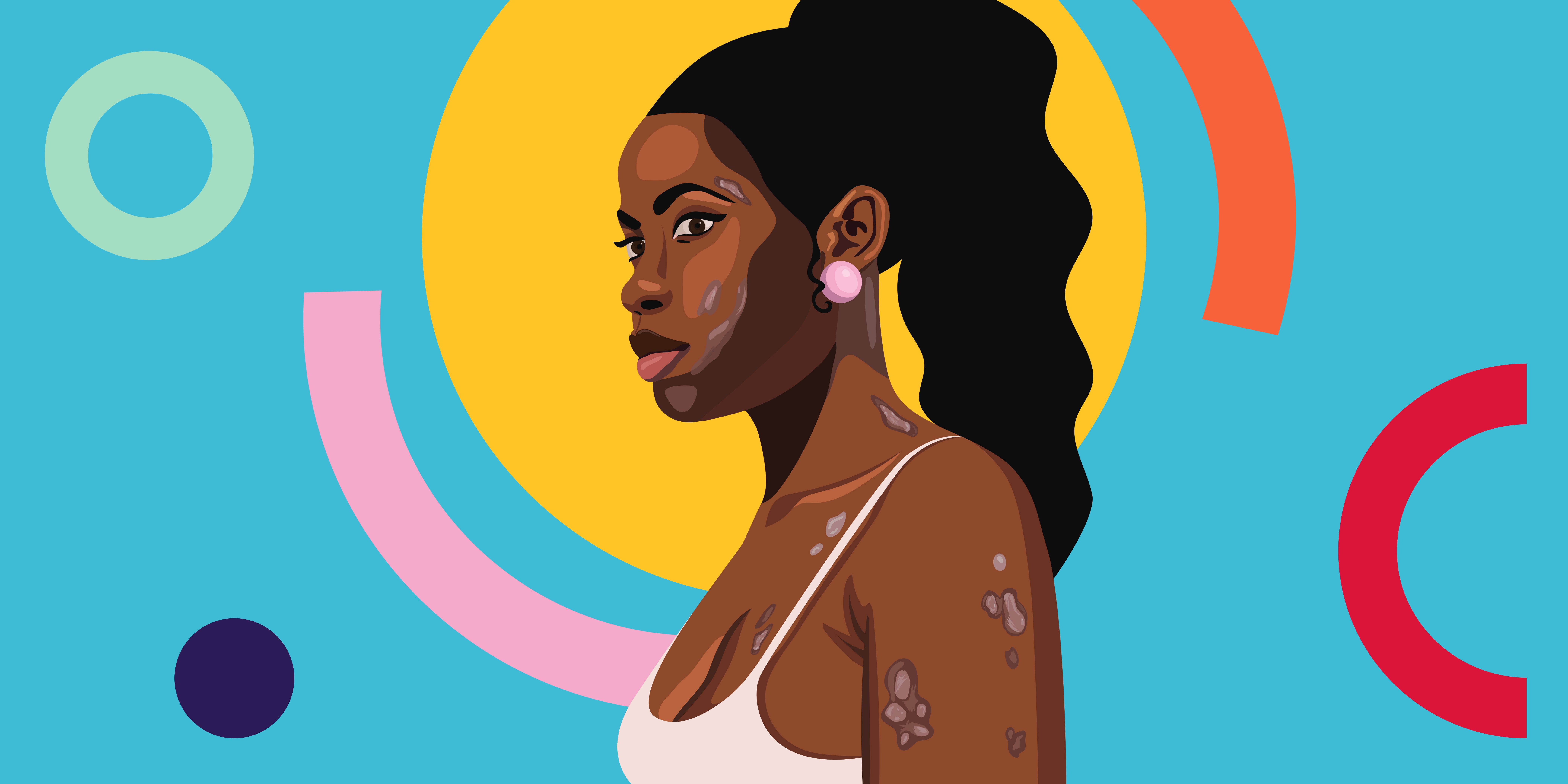 Así es como aparece la psoriasis en la piel negra, y cómo puede diagnosticarse y tratarse