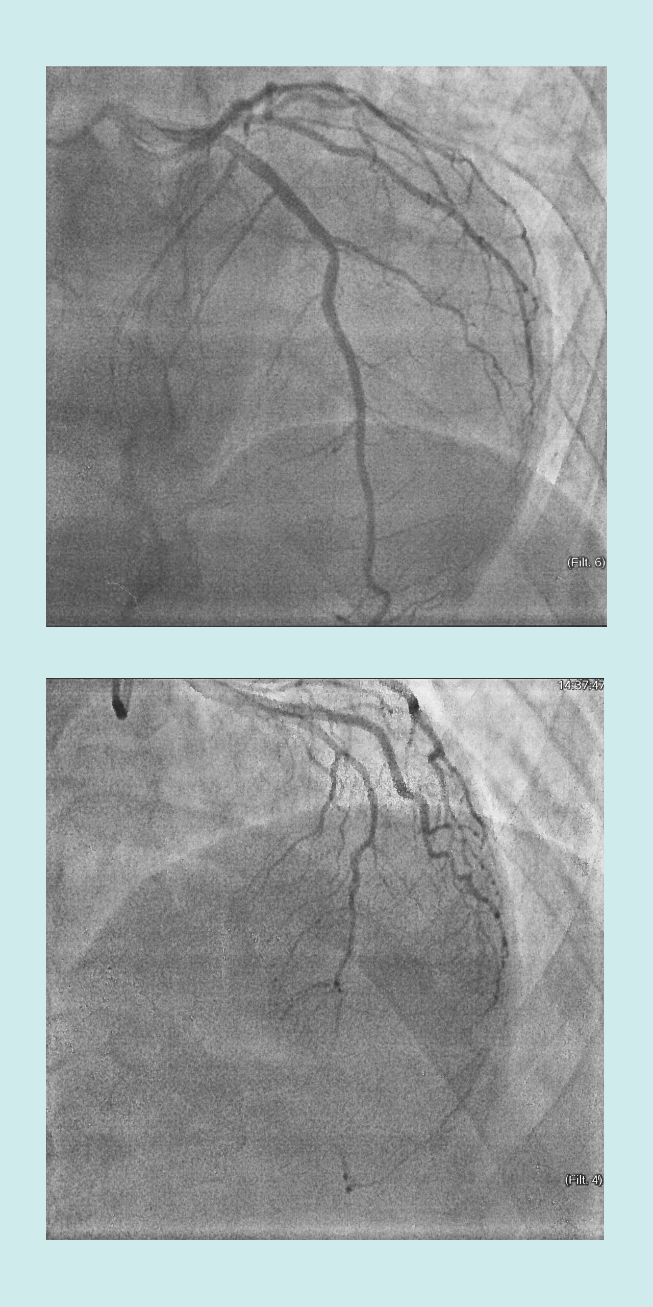 Soy enfermera de cardiología y negué los síntomas de mi infarto durante casi una semana