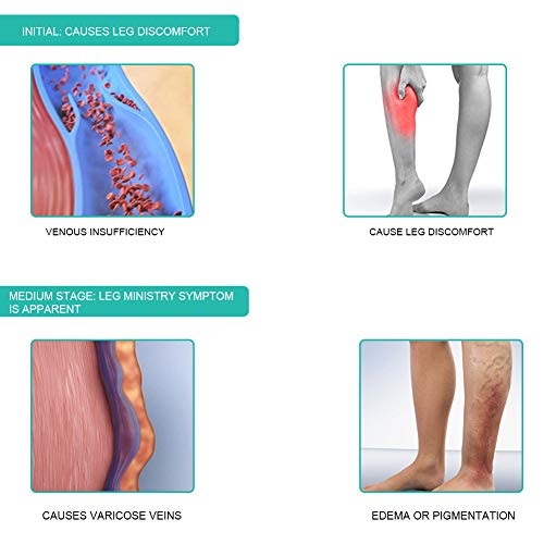 Medias de compresión elásticas opacas, pantimedias de compresión para mujeres y hombres, medias altas hasta el muslo, punta abierta, longitud de la rodilla, venas varicosas(XL)