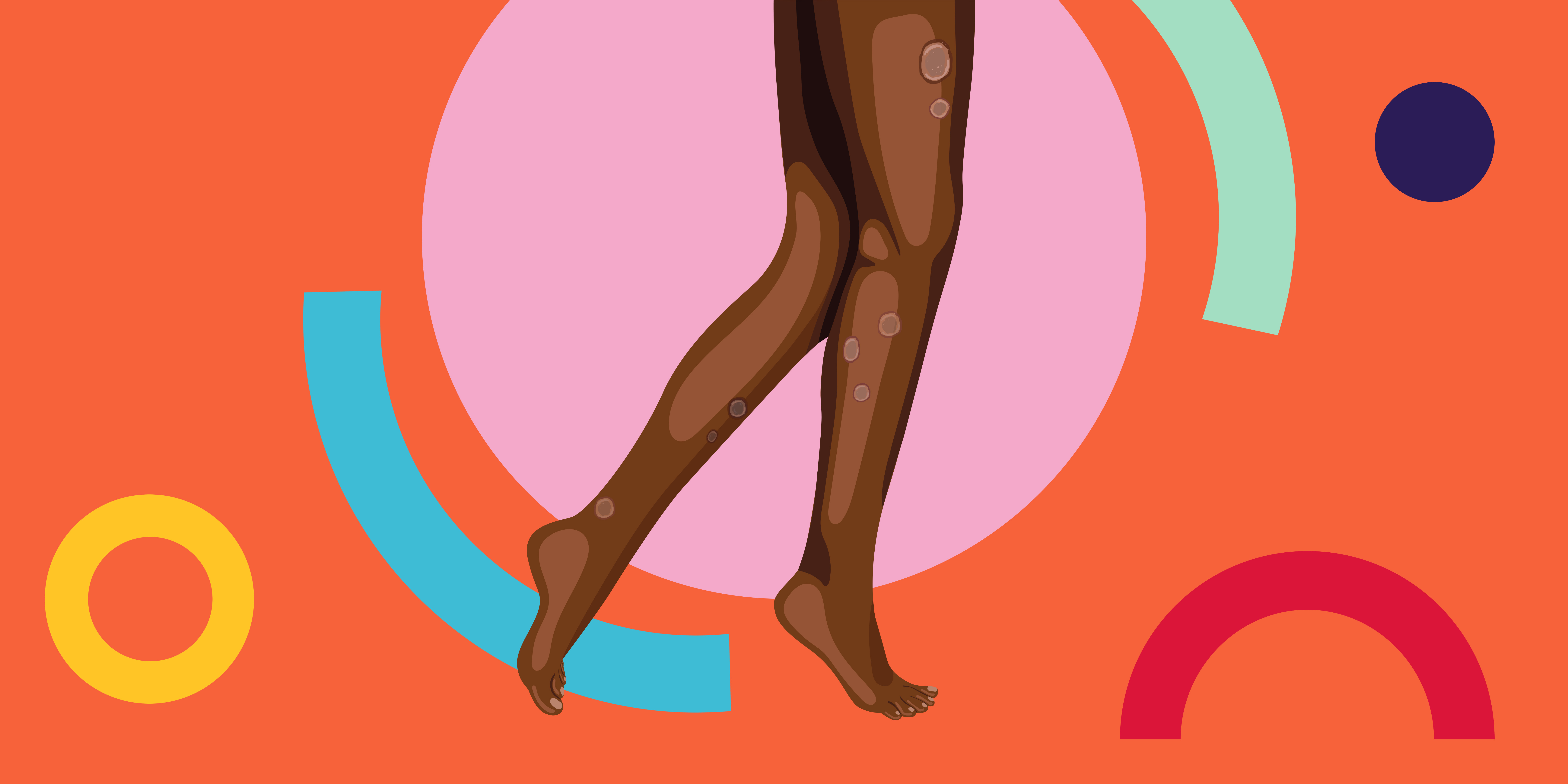 Cómo afecta la tiña a la piel negra y cómo tratarla