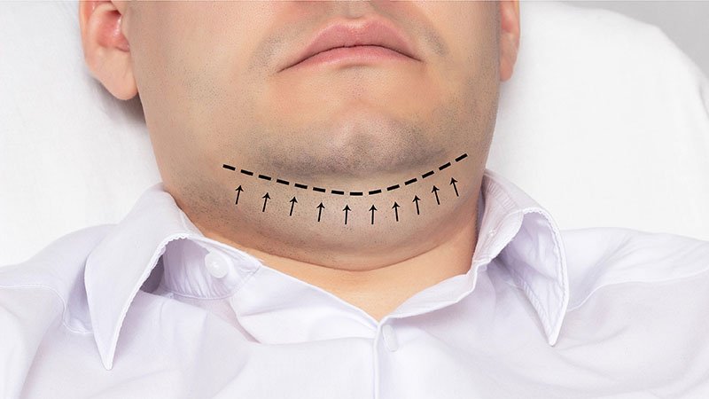 Cómo eliminar la papada