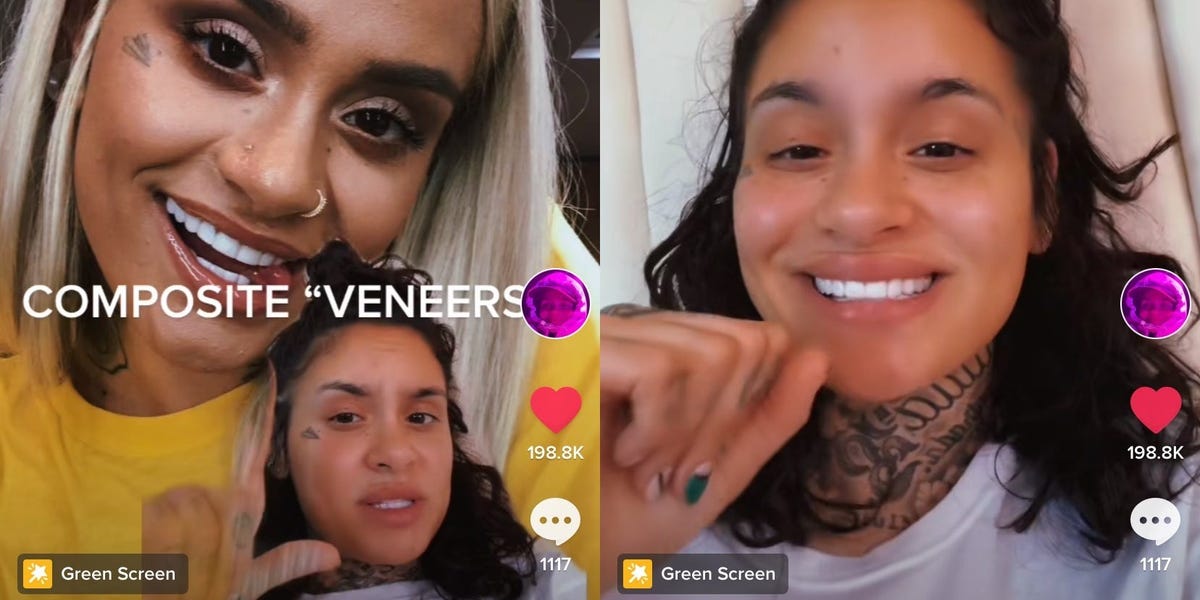 Kehlani dijo que se puso carillas de composite baratas y se arrepiente. Esto es lo que debes saber sobre el procedimiento.