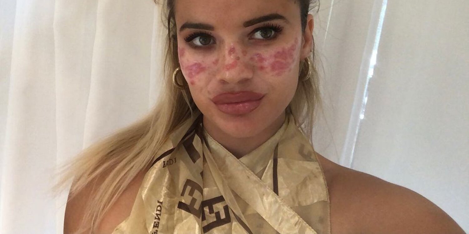 Tilly Whitfield sufre los efectos de un reto viral de TikTok