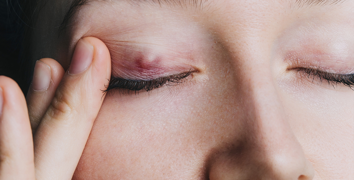 Descubre seis remedios caseros para el orzuelo