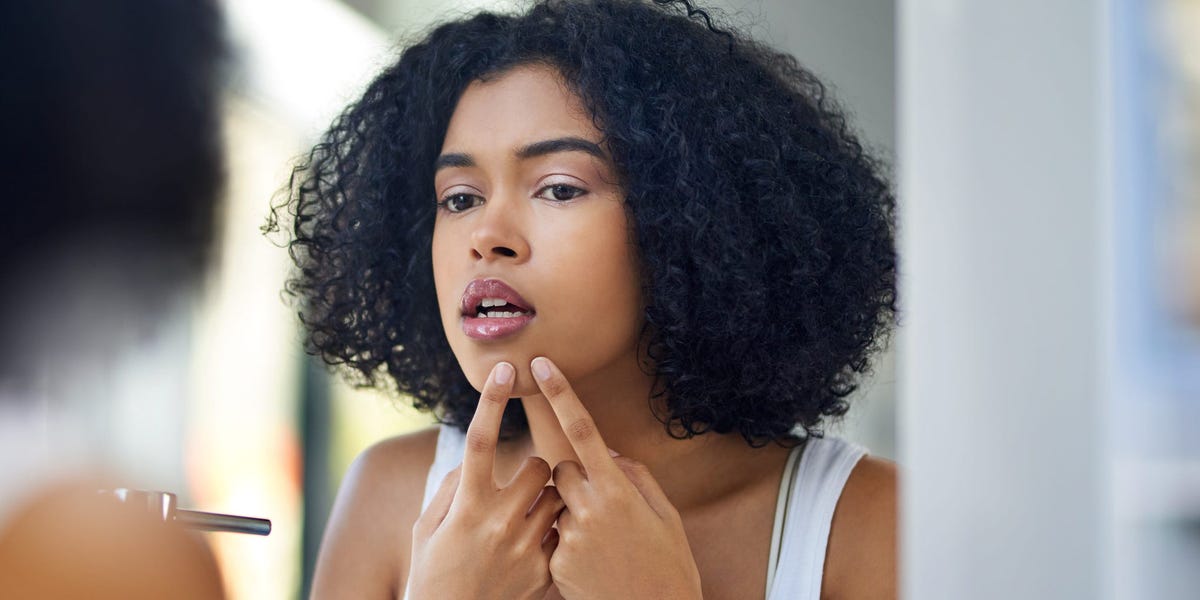 Por qué el uso de la vitamina A en su rutina de cuidado de la piel puede ayudar a tratar el acné y mejorar la salud de la piel