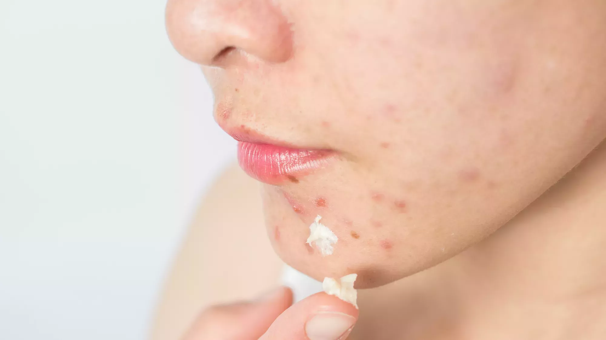 Por qué el azufre es tan bueno para la piel