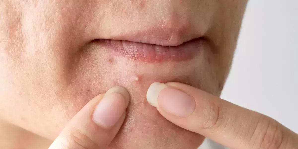 4 de los 'hacks' más perjudiciales para el cuidado de la piel en TikTok, según uno de los dermatólogos estrella de la app